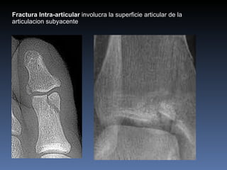 Fractura Intra-articular  involucra la superficie articular de la articulacion subyacente 