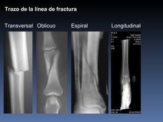 Transversal Oblicuo  Espiral   Longitudinal Trazo de la linea de fractura 
