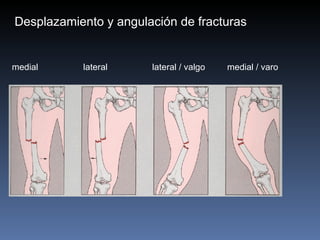 medial   lateral   lateral / valgo  medial / varo     Desplazamiento y angulación de fracturas 