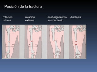 rotacion     rotacion   acabalgamiento  diastasis interna   externa   acortamiento Posición de la fractura 