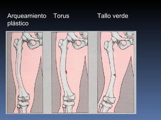 Arqueamiento  Torus  Tallo verde plástico 