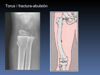 Torus / fractura-abulsión 