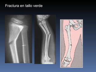 Fractura en tallo verde 