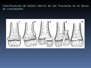 Clasificacion de Salter Harris de las fracturas en el disco de crecimiento 