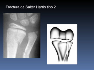Fractura de Salter Harris tipo 2  