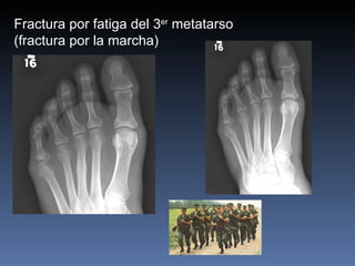 Fractura por fatiga del 3 er  metatarso (fractura por la marcha) 