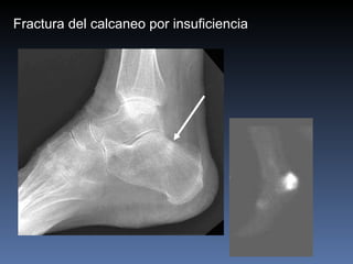 Fractura del calcaneo por insuficiencia 