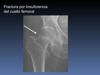 Fractura por Insuficiencia  del cuello femoral 