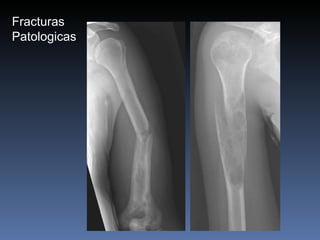 Fracturas Patologicas 