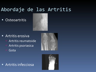 Abordaje de las Artritis Osteoartritis Artritis erosiva Artritis reumatoide Artritis psoriasica Gota Artritis infecciosa  