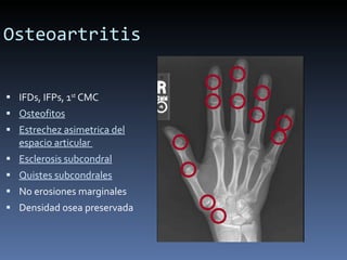 Osteoartritis IFDs, IFPs, 1 st  CMC Osteofitos Estrechez asimetrica del espacio articular  Esclerosis subcondral Quistes subcondrales No erosiones marginales Densidad osea preservada 