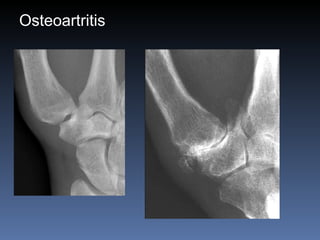 Osteoartritis 