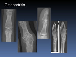 Osteoartritis 