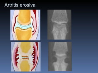 Artritis erosiva 