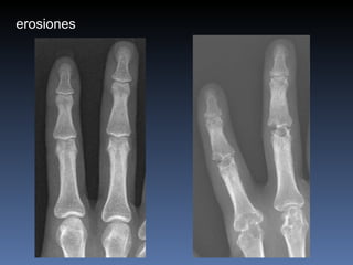 erosiones 