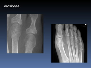 erosiones 