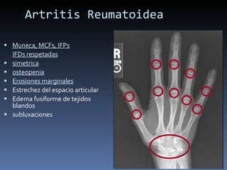 Artritis Reumatoidea Muneca, MCFs, IFPs IFDs respetadas simetrica osteopenia Erosiones marginales Estrechez del espacio articular Edema fusiforme de tejidos blandos subluxaciones 