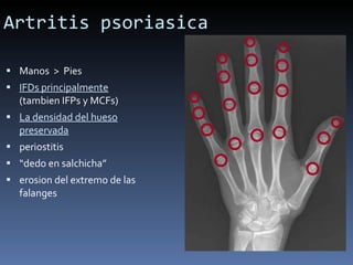 Artritis psoriasica Manos  >  Pies IFDs principalmente  (tambien IFPs y MCFs) La densidad del hueso preservada periostitis “ dedo en salchicha” erosion del extremo de las falanges 