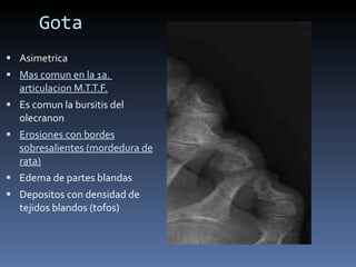 Gota Asimetrica Mas comun en la 1a.  articulacion M.T.T.F. Es comun la bursitis del olecranon Erosiones con bordes sobresalientes (mordedura de rata) Edema de partes blandas Depositos con densidad de tejidos blandos (tofos) 