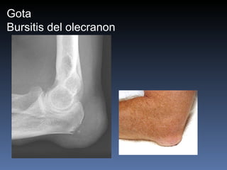 Gota Bursitis del olecranon 