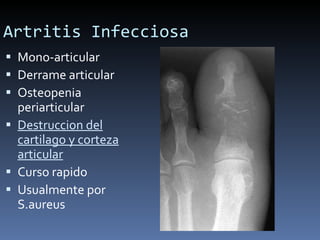 Artritis Infecciosa Mono-articular Derrame articular Osteopenia periarticular Destruccion del cartilago y corteza articular Curso rapido Usualmente por S.aureus 