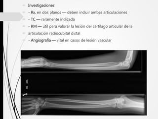  Investigaciones
 - Rx. en dos planos — deben incluir ambas articulaciones
 - TC — raramente indicada
 - RM — útil para valorar la lesión del cartílago articular de la
 articulación radiocubital distal
 - Angiografía — vital en casos de lesión vascular
 