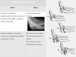 CLASIFICACION DE COLTON
TIPO 1 TIPO 2
Fracturas no desplazas /
desplazamiento mínimo (<2mm) con
el codo en flexión 90° / extensión
contra la gravedad.
Fracturas desplazadas
(>2mm).
Fracturas estables y el paciente
conserva su capacidad de extender
activamente el codo.
2A: Fractura por avulsión
2B: Fractura transversa o
oblicua
2C: Fractura luxación
2D:Fractura conminuta
 