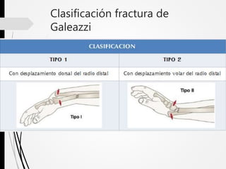 Clasificación fractura de
Galeazzi
 