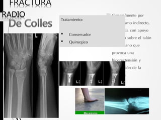 Generalmente por
mecanismo indirecto,
por caída con apoyo
violento sobre el talón
de la mano que
provoca una
hiperextensión y
supinación de la
muñeca
 