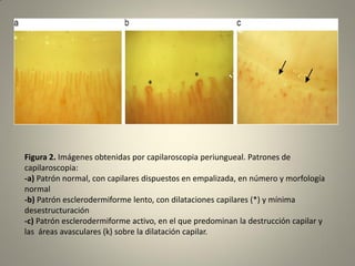 Figura 2. Imágenes obtenidas por capilaroscopia periungueal. Patrones de
capilaroscopia:
-a) Patrón normal, con capilares dispuestos en empalizada, en número y morfología
normal
-b) Patrón esclerodermiforme lento, con dilataciones capilares (*) y mínima
desestructuración
-c) Patrón esclerodermiforme activo, en el que predominan la destrucción capilar y
las áreas avasculares (k) sobre la dilatación capilar.
 