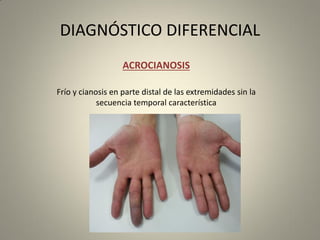 DIAGNÓSTICO DIFERENCIAL
ACROCIANOSIS
Frío y cianosis en parte distal de las extremidades sin la
secuencia temporal característica
 