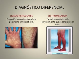 DIAGNÓSTICO DIFERENCIAL
LIVEDO RETICULARIS
Coloración moteada rojo-azulada
persistente en fina retícula.
ERITROMELALGIA
Episodios paroxísticos de
enrojecimiento que se agrava con el
calor.
 