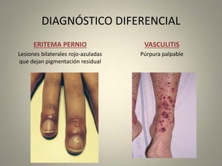 DIAGNÓSTICO DIFERENCIAL
ERITEMA PERNIO
Lesiones bilaterales rojo-azuladas
que dejan pigmentación residual
VASCULITIS
Púrpura palpable
 