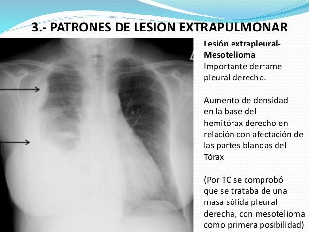 Principales patrones radiológicos en la placa simple de tórax