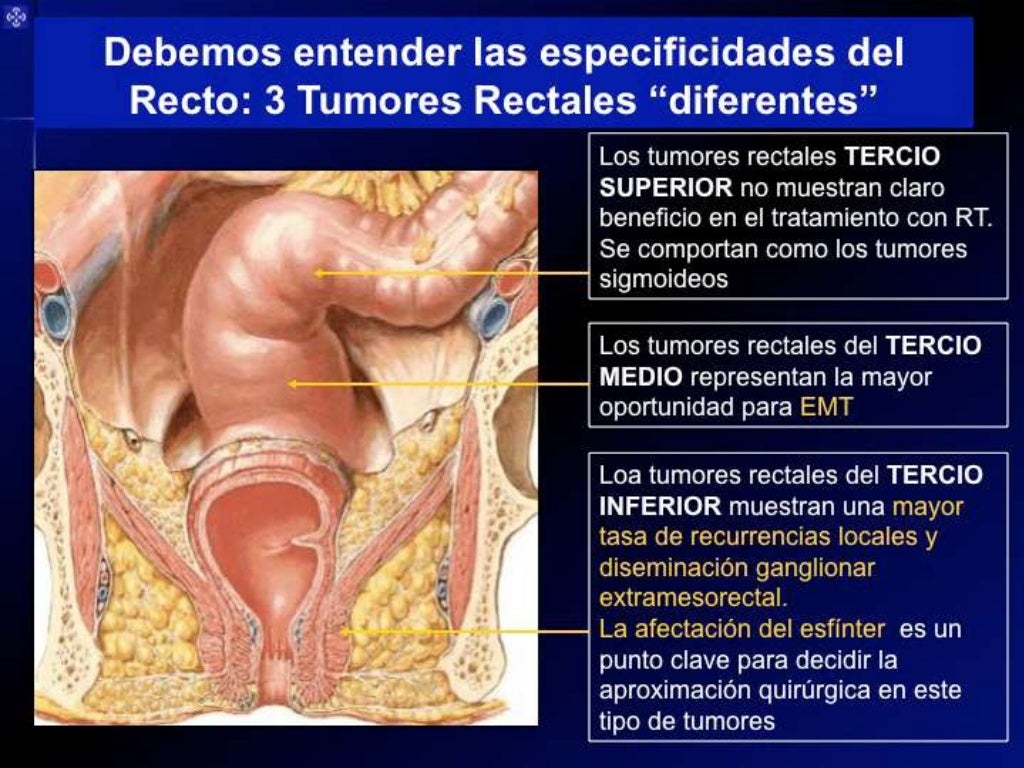 Sesión Vía clínica de Cáncer de Recto