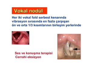 Her iki vokal fold serbest kenar nda
vibrasyon s ras nda en fazla çarp (an
ön ve orta 1/3 k s mlar n n birle(im yerlerinde
Ses ve konu(ma terapisi
Cerrahi eksizyon
Vokal nodVokal nodüüll
 