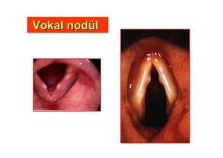 Vokal nodVokal nodüüll
 