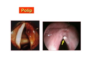 PolipPolip
 