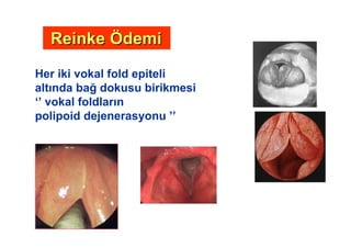 Her iki vokal fold epiteli
alt nda ba dokusu birikmesi
‘’ vokal foldlar n
polipoid dejenerasyonu ’’
ReinkeReinke ÖÖdemidemi
 