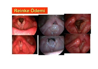 ReinkeReinke ÖÖdemidemi
 