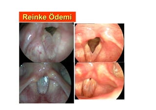 ReinkeReinke ÖÖdemidemi
 