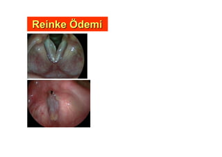 ReinkeReinke ÖÖdemidemi
 
