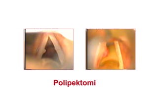 PolipektomiPolipektomi
 