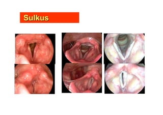 SulkusSulkus
 