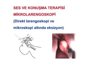 SES VE KONU7MA TERAP S
M KROLARENGOSKOP
(Direkt larengoskopi ve
mikroskopi alt nda eksizyon)
 