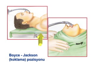 BoyceBoyce -- JacksonJackson
(koklama) pozisyonu(koklama) pozisyonu
 