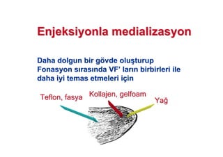 EnjeksiyonlaEnjeksiyonla medializasyonmedializasyon
Daha dolgun bir gDaha dolgun bir göövde oluvde olu((turupturup
FonasyonFonasyon ss rasras nda VFnda VF’’ larlar nn birbirleri ilebirbirleri ile
daha iyi temas etmeleri idaha iyi temas etmeleri iççinin
Teflon,Teflon, fasyafasya KollajenKollajen,, gelfoamgelfoam
YaYa!!
 