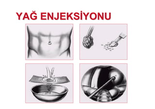 YAYAJJ ENJEKSENJEKS YONUYONU
 