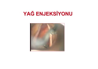 YAYAJJ ENJEKSENJEKS YONUYONU
 