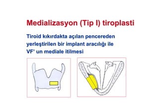 MedializasyonMedializasyon (Tip I)(Tip I) tiroplastitiroplasti
TTiroidiroid kk kk rdakta ardakta açç lanlan penceredenpencereden
yerleyerle((tirilen birtirilen bir implantimplant aracarac ll ileile
VFVF’’ unun medialmedialee itilmesiitilmesi
 